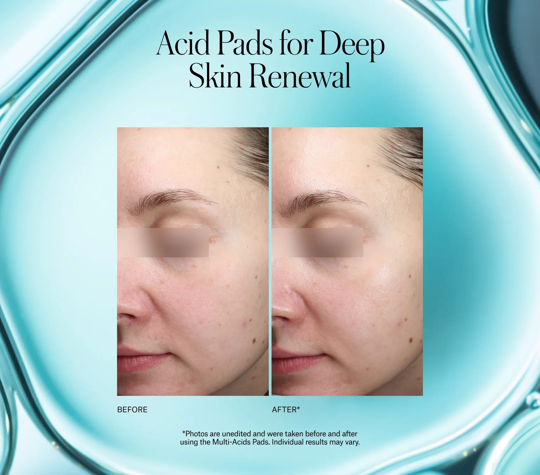 Resurfacing Multi-Acids Pads - Next-Gen